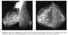 Diagnostic mammogram in a 70-year-old woman who presented with a painless,
swollen erythematous right breast. There was no significant past medical history.