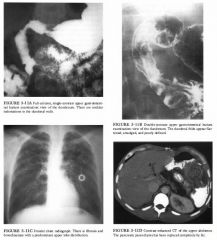 A 33-year-old man presents with dyspepsia. He has had many hospital admissions
since childhood for recurrent pulmonary infections.