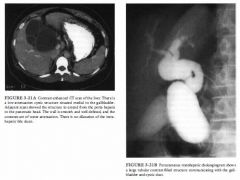 A 30-year-old woman presents with right-upper quadrant pain and intermittent
jaundice.