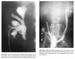 A 70-year-old man has a prior history of urinary tract surgery.