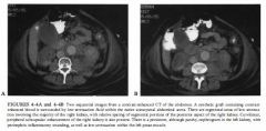 A 63-year-old woman status post abdominal aortic aneurysm repair presents with
abdominal pain, fever, leukocytosis.