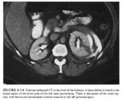 A 41 -year-old man involved in a motor vehicle accident presents with microscopic
hematuria.