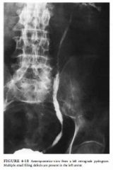 A 62-year-old man has a history of chronic urinary tract infections