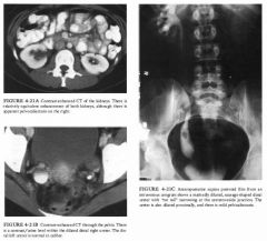 A I S-year-old boy has a history of urinary tract infections.
