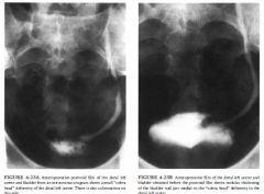 A 72-year-old woman presents with hematuria