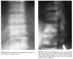 A 33-year-old woman with diffuse bone pain and a chronic disease