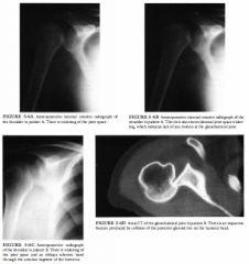 Patient A: a 35-year-old man who fell from a ladder onto an outstretched hand and
now complains of shoulder pain. Patient B : a 45-year-old woman who complains of
severe shoulder pain following a grand mal seizure.