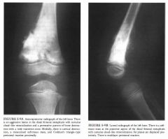 A 3-year-old boy with pain and a flrm mass at the upper part of his left knee