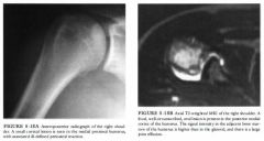 A 19-year-old man who lifts weights has persistent pain in his right shoulder.