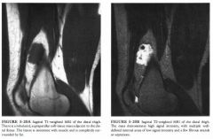 A 1 7 -year-old girl with a palpable mass in the distal thigh deep to the
quadriceps muscle.