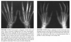 A 43-year-old woman with morning stiffness, pain, and swelling in the joints of the
wrists and fmgers bilaterally.