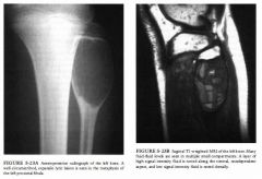 A 1 2-year-old boy with a painless palpable mass along the lateral aspect of the left knee.