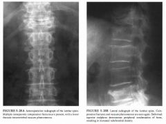 A 66-year-old woman with chronic obstructive pulmonary disease ( COPD) and
back pain.
