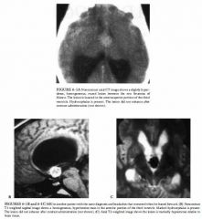 A 14-year-old girl with morning headaches and papilledema