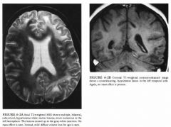 A 26-year-old woman with acquired immunodeficiency syndrome (AIDS) and
deteriorating mental status.