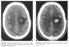 A 37-year-old man with mild right hemiparesis and headache.
FIGURE 6-