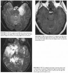 A 57-year-old woman with fever, confusion, and a nonfoca1 neurologic examination