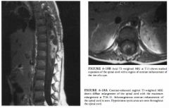 A 1 3-year-old girl with weakness in both legs and incontinence.