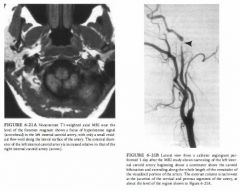 A 38-year-old woman with unremitting left-sided headache and oculosympathetic
paresis of 2 weeks' duration.