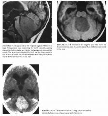 A 6-year-old boy with headache and ataxia.