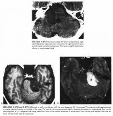 A 73-year-old woman with right seventh nerve dysfunction