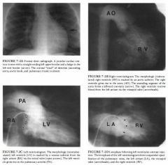 A 1 2-year-old girl with a 6-year history of exertional dyspnea and palpitations.