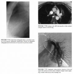 A 58-year-old woman with substernal pleuritic chest pain and new dyspnea on
exertion. She subsequently experienced an episode of transient hemiplegia following
infusion of an intravenous catheter with saline.