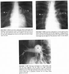 An I 8-year-old woman with exertional dyspnea with chest pain for 1 8 months