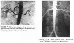 Two patients with hypertension: patient A, shown in Figure 7 - I IA, is a 67-year-old
man with an abdominal bruit; patient B, shown in Figure 7 - l I B, is a 37-year-old
woman with hypertension of recent onset.