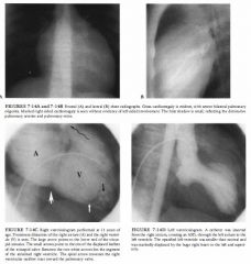 A I S-year-old boy with easy fatiguability, exertional dyspnea, cyanosis, and intermittent
chest pain of 4 years' duration.