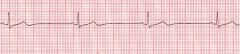 What ECG rhythm is this? How do you recognize it?