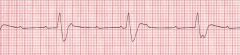 What ECG rhythm is this? How do you recognize it?