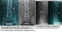 Ankylosing Spondylitis - aka Bamboo spine