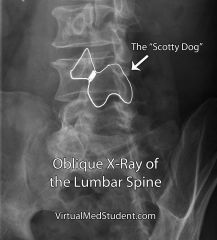 Spondylolysis - aka "scotty dog fracture" - unilateral fracture of pars interarticularis