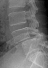 What is occurring in this x-ray?