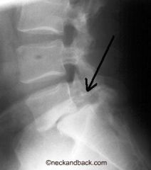 Spondylolisthesis - slippage due to fracture of pars interarticularis (bilaterally?)