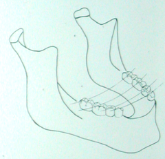 right to left curvature of the occlusal plane of posterior teeth (perpendicular to Curve of Spee)