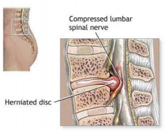 Compression of spinal nerves and roots due to injured intervertebral disc.
Most common in cervical and lumbar regions 
Results in pain and muscle weakness