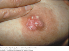 An intra-epidermal spread of intraduct cancer which can look like eczema 