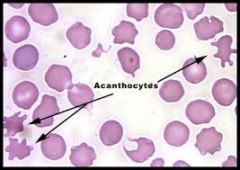 Also known as a spur cell, is a irregular red cell with few unevenly distributed projections of various lengths & diameter