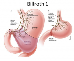 Billroth I
- gastroduodenostomy (for GU)
- to ↓ stomach capacity 
  * so, food direct to duodenum

