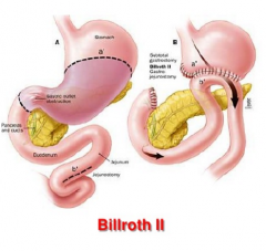 Billroth II
- gastrojejunostomy (for DU)
- quick emptying of stomach
- leave duodenum there (needed for digestion)
  * income of pancreatic juice / bile
