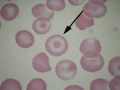 Also known as a Leptocyte or Codocyte, thin erythrocytes with target shaped central pallors