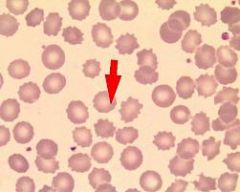 Also known as a burr cell is a spiculated cell with numerous short, evenly spaced, blunt or sharp projections