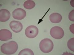 Basophilic nuclear remnants seen in young RBCs