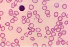 Decreased staining in RBCs due to insufficient hemoglobin