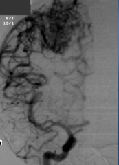 Du utfører en angiografi av cerebrale kar ved å sprøyte inn kontrast i a.carotis interna (via kateter inn i a.femoralis), og ser dette. Hva er problemet?