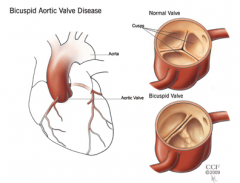 3-this is a typically tricuspid valve; however 0.5% of the population including Arnold Schwarzenegger have a bicuspid valve