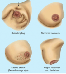 Painless lump or thickening, change in size, nipple discharge, dimpled skin, and peau d'orange (lymphatic blockage)
