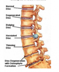 Degenerated disc
Bulging disc
Herniated disc
Thinning disc (loss of water, zygopophyseal joint damage)
Disc degeneration with osteophyte formation